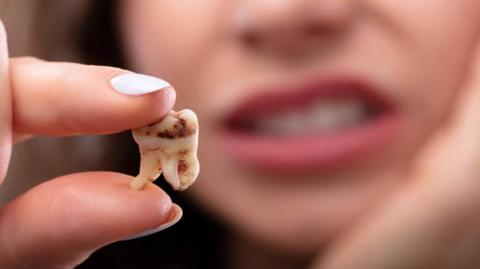 تسوس الأسنان: ماهي خيارات العلاج؟